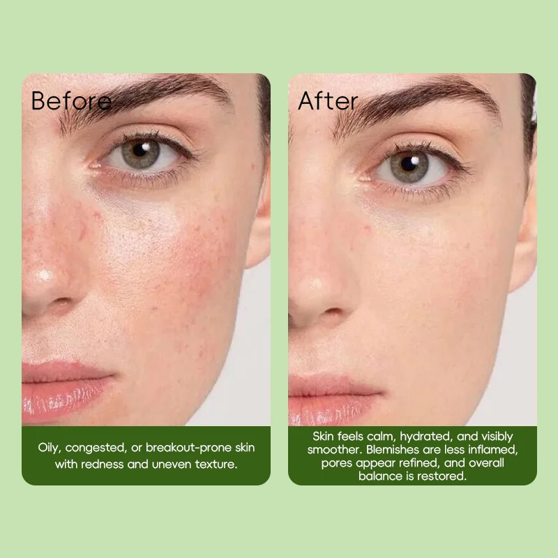 Side by side comparison of a person's skin before and after skincare treatment, showing reduction in redness and improved texture.